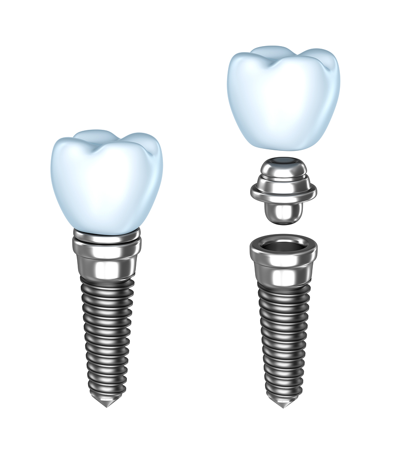 dental implants in North Syracuse, NY